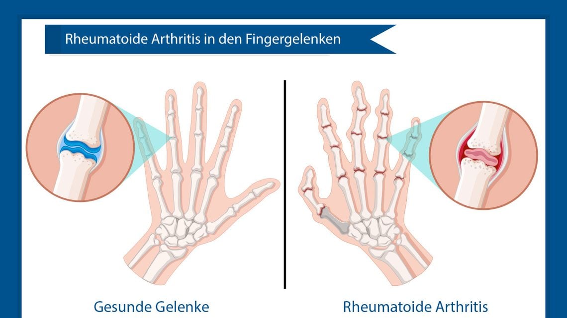 Rheumatoide Arthritis: Die häufigste Form der chronischen Gelenkentzündung